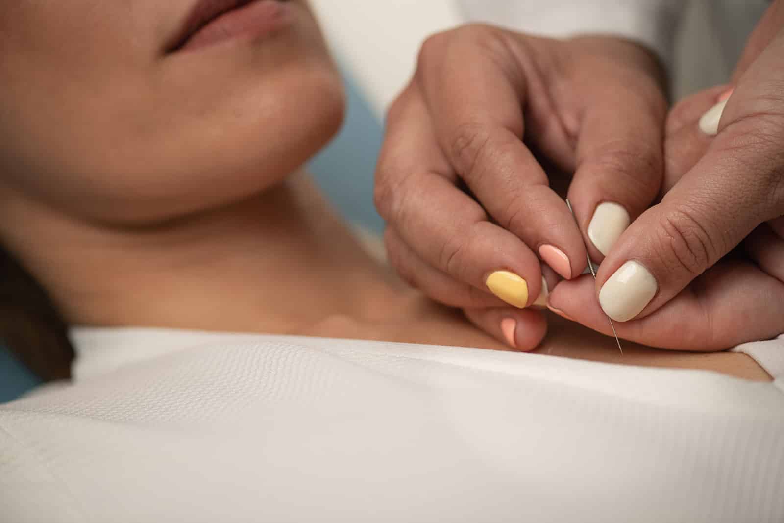 Acupuncture Beemer Back Center Springdale AR